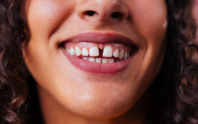 Diastema dental: qué es, causas, efectos y tratamiento