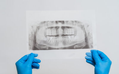 ¿Cómo influye la osteoporosis en la colocación de implantes dentales?