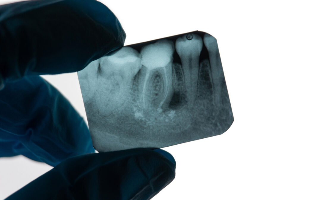 ¿Cómo saber si necesito una endodoncia? Síntomas que no debes ignorar