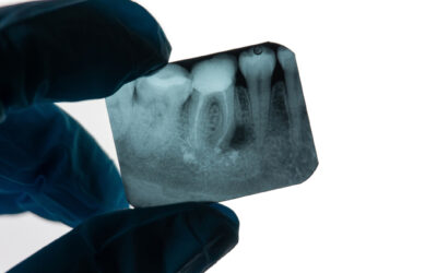 ¿Cómo saber si necesito una endodoncia? Síntomas que no debes ignorar