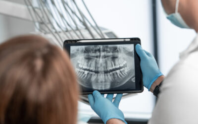 Caries interproximales: el enemigo invisible entre los dientes