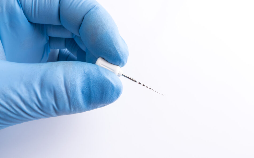 Cuándo una caries necesita endodoncia