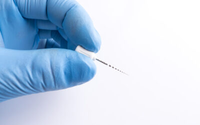 Cuándo una caries necesita endodoncia